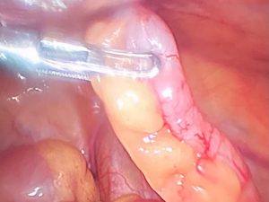 Laparoscopic hernia surgeon in Udgir