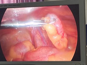 Laparoscopic hernia surgeon in Udgir