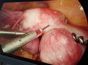 Gallstones laparoscopic surgeon in Udgir