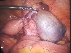 Gallstones laparoscopic surgeon in Udgir